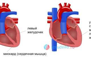 Спортивное сердце (синдром сердца спортсмена): развитие, симптомы, диагностика, чем грозит