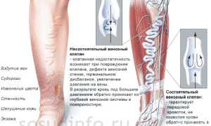 Варикозная экзема (дерматит) нижних конечностей: причины, симптомы, лечение