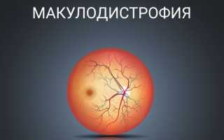 Макулодистрофия сетчатки глаза (макулярная дегенерация)