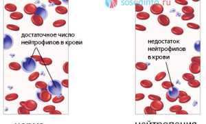 Повышенные лимфоциты в крови при пониженных нейтрофилах: обзор и сопоставление причин