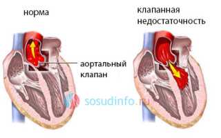 Пластика клапанов сердца: показания к операции, проведение, результат и реабилитация