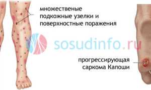 Саркома Капоши: признаки, формы, течение, диагностика, как лечить