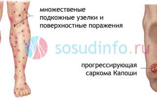 Саркома Капоши: признаки, формы, течение, диагностика, как лечить