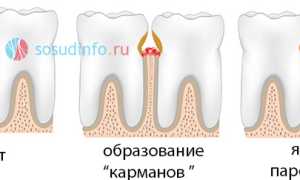 Кровоточивость десен: причины, признаки, лечение, профилактика