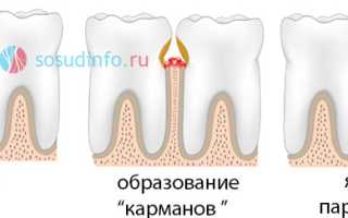 Кровоточивость десен: причины, признаки, лечение, профилактика