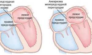 Аневризма межпредсердной перегородки (МПП): причины, симптомы, диагностика, лечение, прогноз