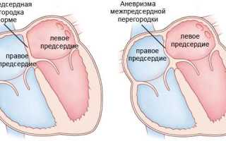 Аневризма межпредсердной перегородки (МПП): причины, симптомы, диагностика, лечение, прогноз