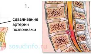 Экстравазальная компрессия позвоночных артерий: симптомы, проявления, диагностика, терапия