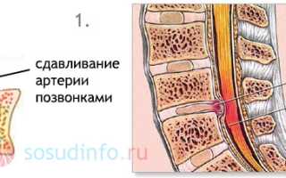 Экстравазальная компрессия позвоночных артерий: симптомы, проявления, диагностика, терапия
