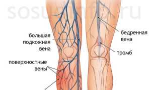 Тромбофлебит глубоких и поверхностных вен: острый и хронический. Диагностика, лечение, профилактика