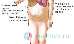 Одышка: сердечная и другие виды – почему появляется, как избавиться и вылечить