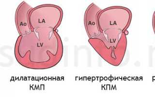 Гипертрофическая кардиомиопатия: причины, проявления, диагностика, как лечить, прогноз