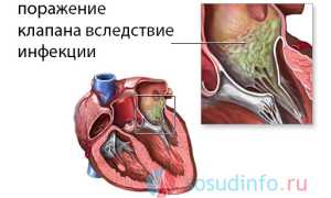 Стеноз митрального клапана: как возникает, причины, симптоматика, диагностика, лечение