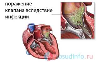 Стеноз митрального клапана: как возникает, причины, симптоматика, диагностика, лечение