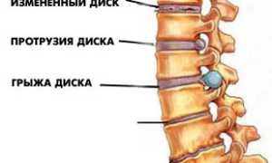 Остеохондроз и его влияние на кровоснабжение: причины и проявления болезни, диагностика, терапия, профилактика