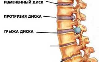 Остеохондроз и его влияние на кровоснабжение: причины и проявления болезни, диагностика, терапия, профилактика