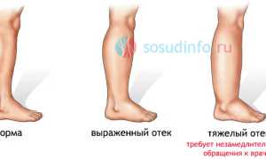 Отеки на ногах: почему появляются, факторы риска, чем снимать и лечить?