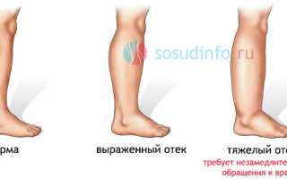 Отеки на ногах: почему появляются, факторы риска, чем снимать и лечить?