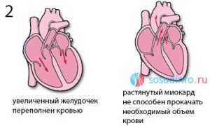 Недостаточность сердечных клапанов: причины, симптомы, лечение, прогноз