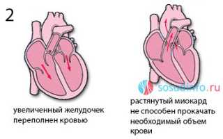 Недостаточность сердечных клапанов: причины, симптомы, лечение, прогноз