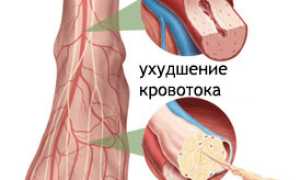 Макроангиопатия: развитие, виды, локализации, диагноз, лечение, прогноз