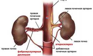 Стеноз почечных артерий (ПА): причины, признаки, диагностика, как лечить, операция