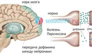 Болезнь Паркинсона: причины возникновения, проявления, стадии, лечение