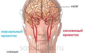 Спазм сосудов головы: причины, как снять и лечить?