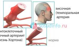 Артериит: причины, симптомы, лечение, прогноз, формы