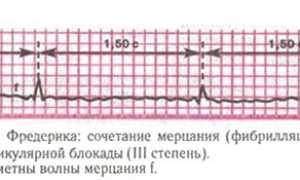 Синдром Фредерика: возникновение и причины, симптомы и диагностика, как лечить