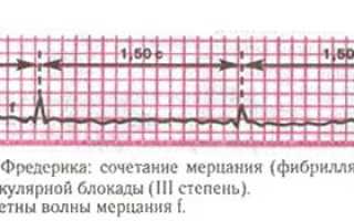 Синдром Фредерика: возникновение и причины, симптомы и диагностика, как лечить