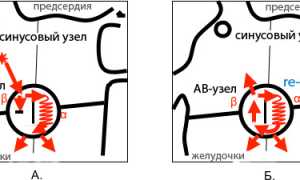 АВ-узловая тахикардия: механизм возникновения, клиника, диагностика и ЭКГ, лечение