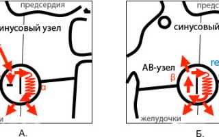 АВ-узловая тахикардия: механизм возникновения, клиника, диагностика и ЭКГ, лечение