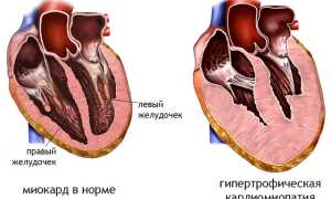 Масса миокарда: суть, норма, расчет и индекс, о чем говорит
