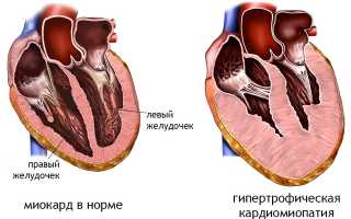Масса миокарда: суть, норма, расчет и индекс, о чем говорит