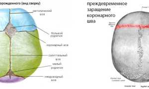 Брахицефалия: что это, причины и развитие, проявления, диагноз, как лечить