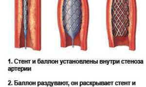 Ангиопластика: суть, показания, виды, стоимость, проведение процедуры