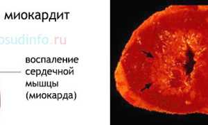 Патологические изменения миокарда: умеренные и выраженные – причины, прогноз, лечение
