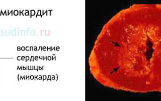 Патологические изменения миокарда: умеренные и выраженные – причины, прогноз, лечение