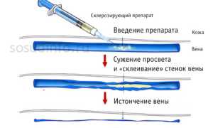 Склеротерапия вен ног: эффективный метод для незапущенного варикоза