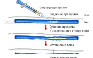 Склеротерапия вен ног: эффективный метод для незапущенного варикоза