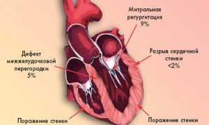 Кардиогенный шок: возникновение и признаки, диагностика, терапия, прогноз