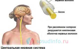 Рассеянный склероз (РС): из-за чего появляется, признаки и течение, диагностика, терапия, излечим или нет?