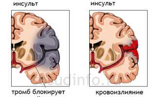 РЭГ сосудов головы: когда делать обследование и как его расшифровать?