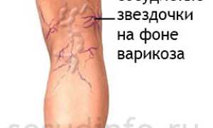 Сосудистые звездочки на лице и ногах: причины появления, как удалить