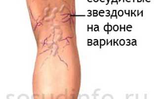 Сосудистые звездочки на лице и ногах: причины появления, как удалить