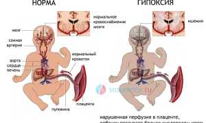 Лейкомаляция у новорожденных: причины, последствия, симптомы, лечение