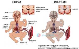 Лейкомаляция у новорожденных: причины, последствия, симптомы, лечение