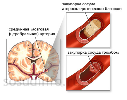 Возникновение мозговой ишемии