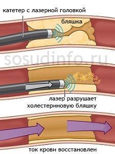 Лазерная ангиопластика